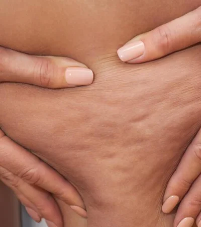 Hay alimentos que ayudan a que se retenga líquido en el organismo./