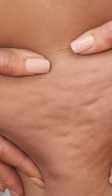 Hay alimentos que ayudan a que se retenga líquido en el organismo./