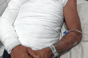 Su hermano le prendió fuego tras discutir por un sachet de mayonesa