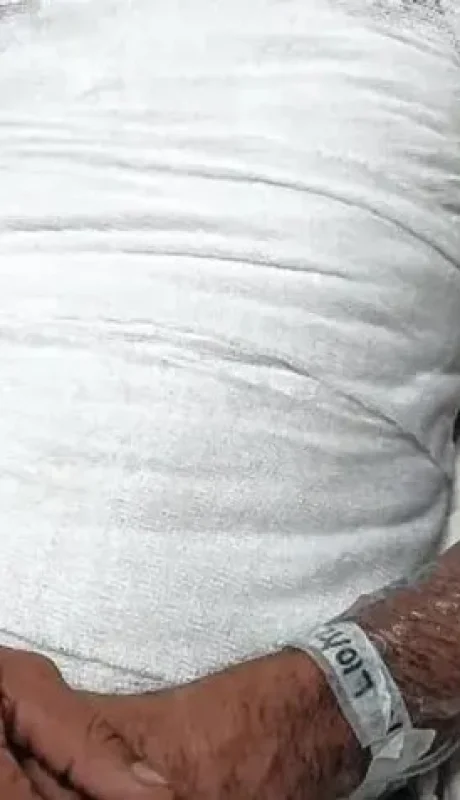 Su hermano le prendió fuego tras discutir por un sachet de mayonesa