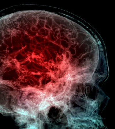 Un estudio descubrió niveles alarmantes de microplásticos en el cerebro.