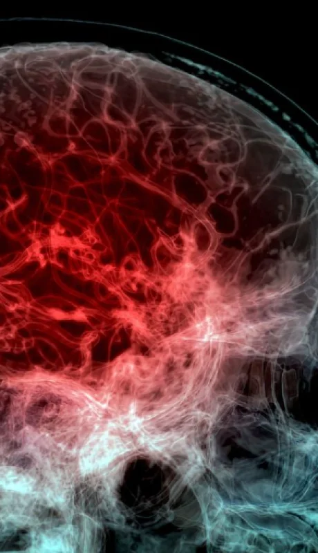 Un estudio descubrió niveles alarmantes de microplásticos en el cerebro.