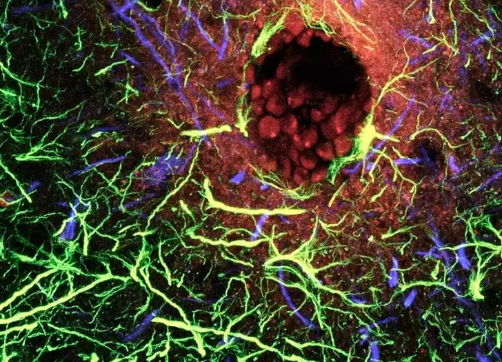 Esta imagen muestra una ruptura de la barrera hematoencefálica. Se ha inyectado un trazador fluorescente (rojo) en la sangre.