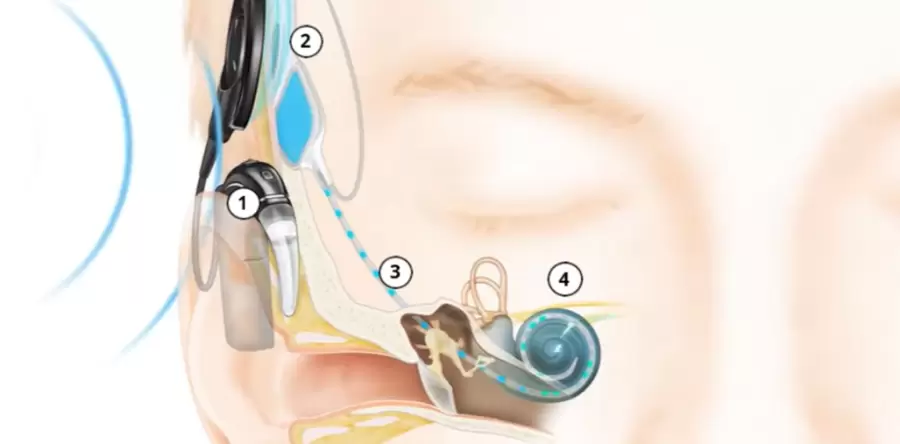 implante coclear grafico