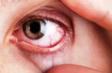 Frotarse los ojos y el alto riesgo de padecer lesiones e infecciones