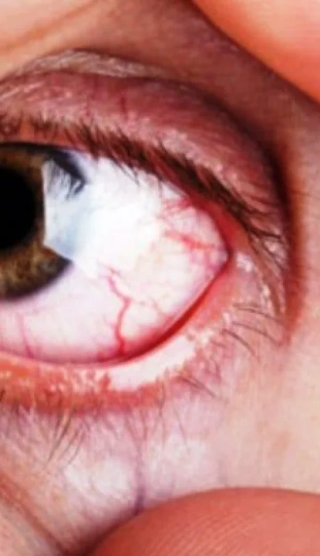 Frotarse los ojos puede producir derrames o lesiones mucho más importantes en la córnea.