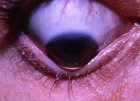 El queratocnono es una deformación producida, la mayoría de las veces, por frotarse demasiado los ojos.