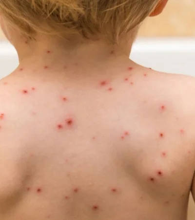 Alerta por sarampión: el Gobierno refuerza la vacunación ante el aumento de casos