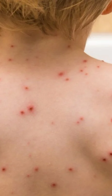 Alerta por sarampión: el Gobierno refuerza la vacunación ante el aumento de casos