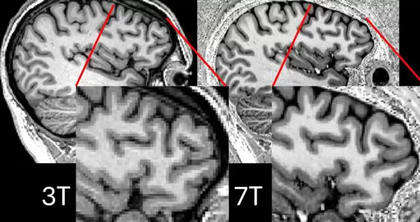 Diferencias de 3T y 7T del mismo participante (Créditos:Simon Jones, Universidad de Cambridge).