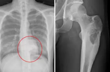 Osteoblastoma: síntomas, estudios y tratamiento recomendado