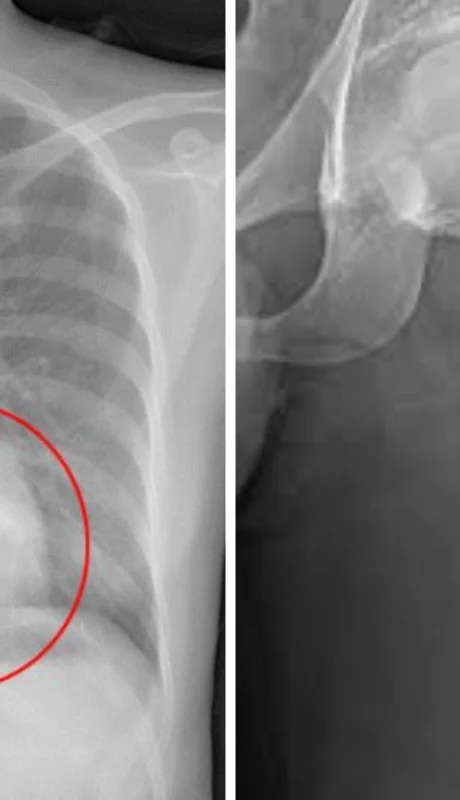 Imagen ilustrativa de osteoblastomas detectados.