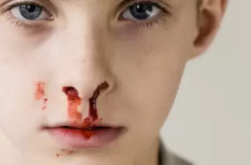 Si tenés hemofilia, el sistema tiene la obligación de atenderte