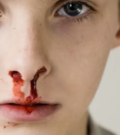 Los tratamientos para la hemofilia pueden ayudar a controlar la enfermedad, aunque no existe cura conocida.