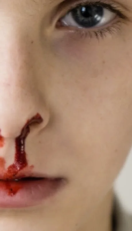 Los tratamientos para la hemofilia pueden ayudar a controlar la enfermedad, aunque no existe cura conocida.