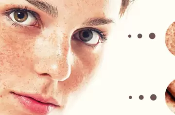 Melanoma, el inquilino malo de la piel que puede derivar en cáncer