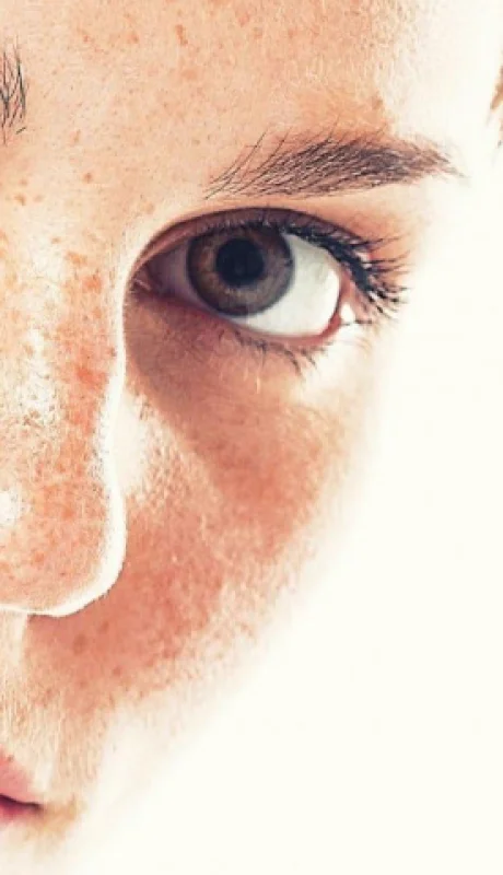 El melanoma es un tumor melánico, pigmentado. Puede ser benigno o maligno.