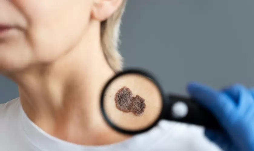 El cáncer de piel es uno de los tipos más comunes de cáncer en el mundo, pero también es uno de los más prevenibles y tratables.