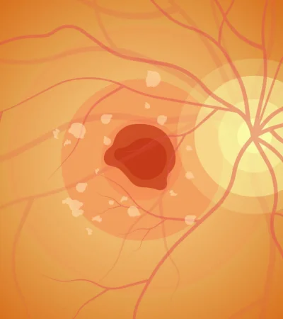 Enfermedad de Stargardt. La degeneración precoz de la retina.