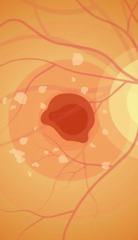 Enfermedad de Stargardt. La degeneración precoz de la retina.