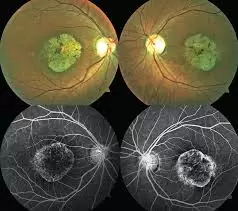 El fondo de ojo que evidencia el problema.