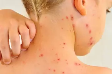 El brote de sarampión en Argentina y cómo se prepara Mendoza