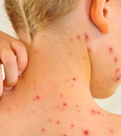 Alerta por sarampión en el país: la vacuna, clave para frenar contagios.