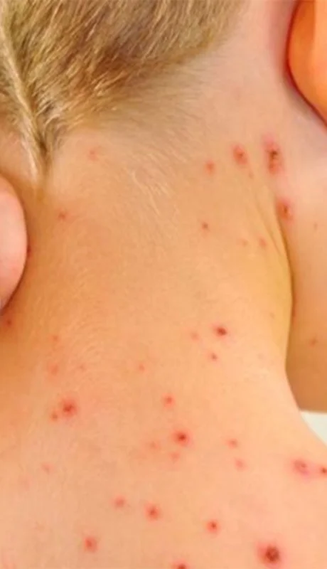 Alerta por sarampión en el país: la vacuna, clave para frenar contagios.