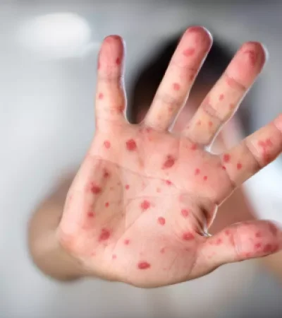 Lesiones típicas de la viruela del mono.