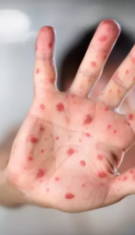 Lesiones típicas de la viruela del mono.