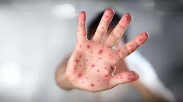 Lesiones típicas de la viruela del mono.