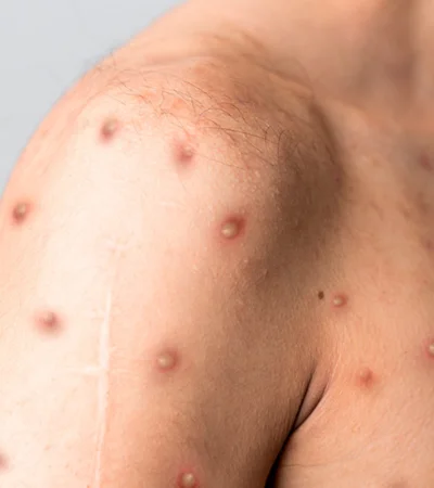 Los dos casos de Mpox se dan en un contexto de transmisión intrafamiliar.