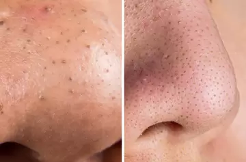 Manchas negras en el rostro: qué son y por qué no deberías cerrarlas