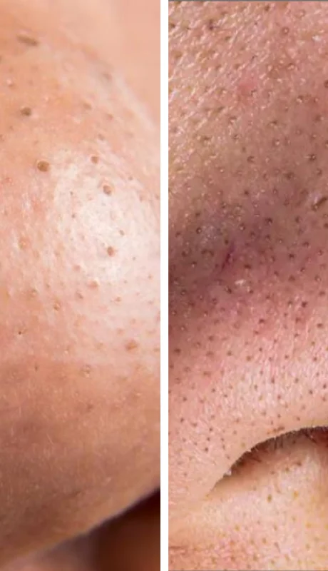 Guía para prevenir y tratar los puntos negros sin errores comunes.