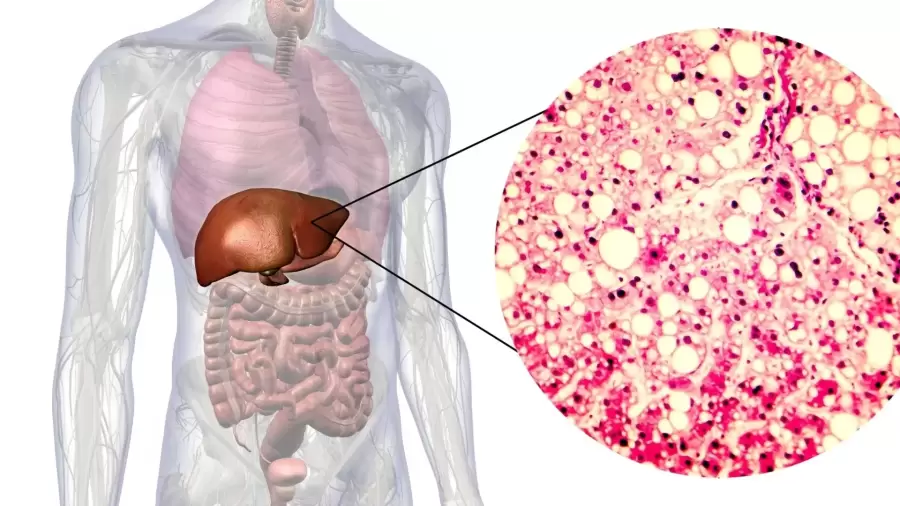 El hígado graso puede ser alcohólico, o no alcohólico.