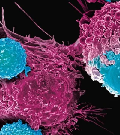 La revolucionaria terapia CAR-T agrega nuevas posibilidades para avanzar sobre el mayor flagelo que asola a la humanidad.