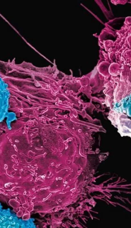 La revolucionaria terapia CAR-T agrega nuevas posibilidades para avanzar sobre el mayor flagelo que asola a la humanidad.