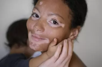 Mitos sobre el vitíligo: qué es cierto y qué no, según una dermatóloga