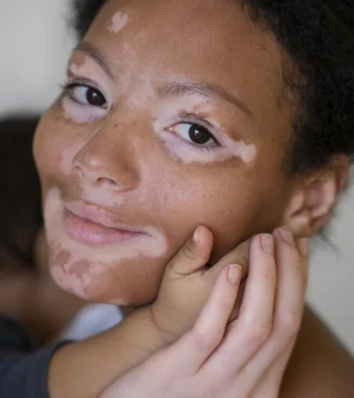 Vitíligo y sistema inmune: lo que tu piel revela sobre tu salud.