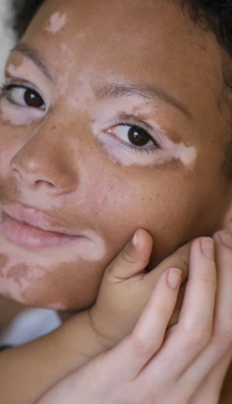 Vitíligo y sistema inmune: lo que tu piel revela sobre tu salud.