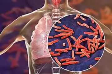 Los casos de tuberculosis aumentaron un 38% en Argentina y siembran preocupación