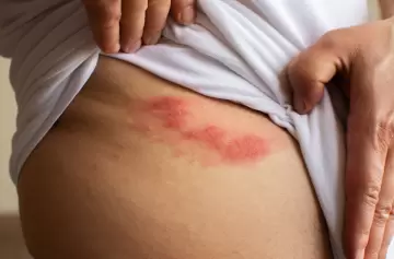 Herpes zóster en adultos mayores: crecen los casos y alertan por secuelas dolorosas