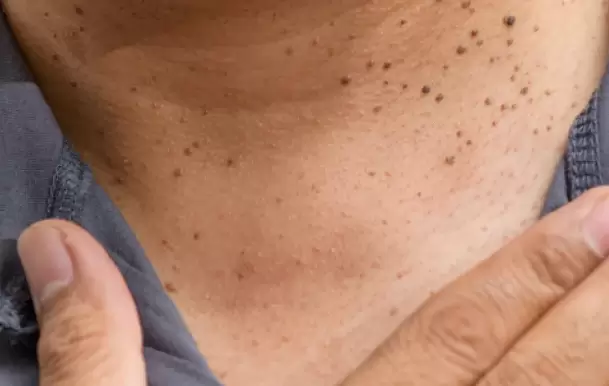 Los acrocordones, también conocidos como papilomas cutáneos, son pequeñas formaciones benignas de piel que suelen aparecer en zonas como en el cuello.