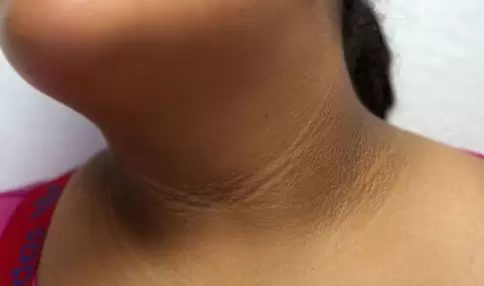 La piel afectada por AN presenta manchas oscuras, engrosadas y con una textura aterciopelada o similar a la suciedad.