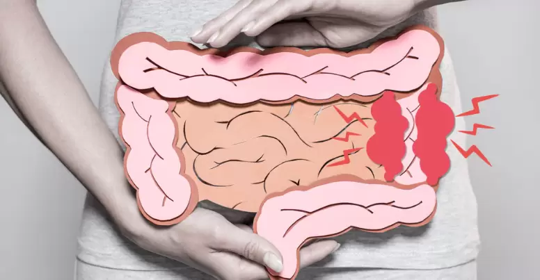 El 31 de marzo se conmemora el Día Mundial contra el Cáncer de Colon, con el objetivo de concienciar a sobre la importancia de este tumor.