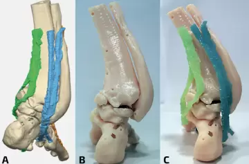 El futuro ya llegó: impresión 3D en cirugías traumatológicas en Mendoza