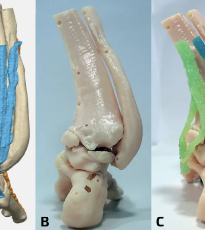 Avance médico en Mendoza: tecnología 3D revoluciona la cirugía.
