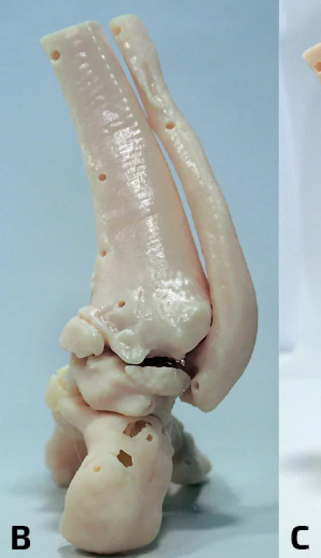 Avance médico en Mendoza: tecnología 3D revoluciona la cirugía.