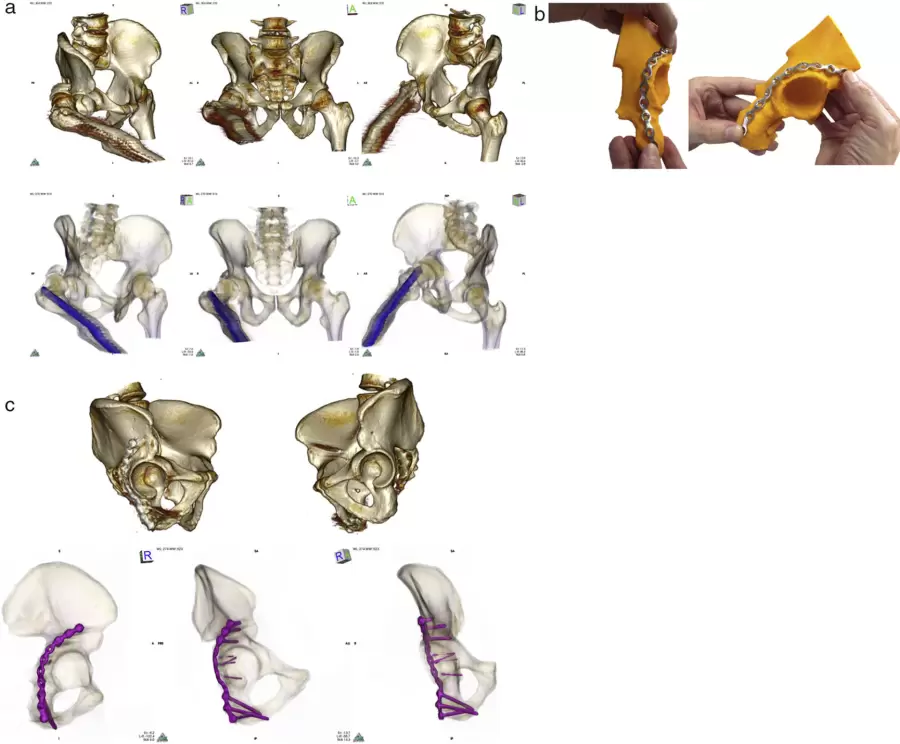 Cómo la impresión 3D está transformando la traumatología en Argentina.