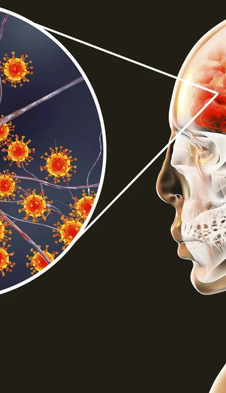 Según la OMS, una de cada seis personas que la contrae muere y una de cada cinco sobrevive con secuelas permanentes.